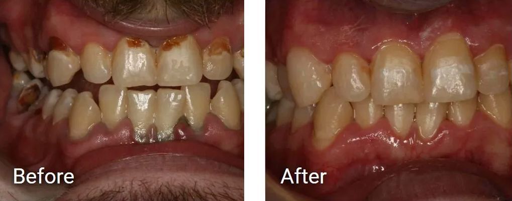 A before and after picture of a man's teeth.