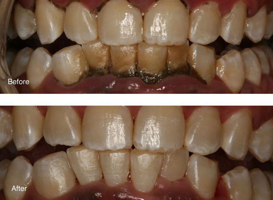 A before and after picture of a person's teeth.