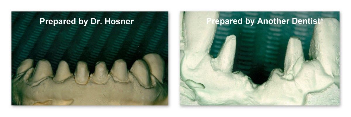 Two pictures of teeth with the words prepared by dr. hosier and prepared by another dentist