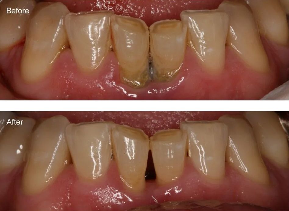 A before and after picture of a person's teeth