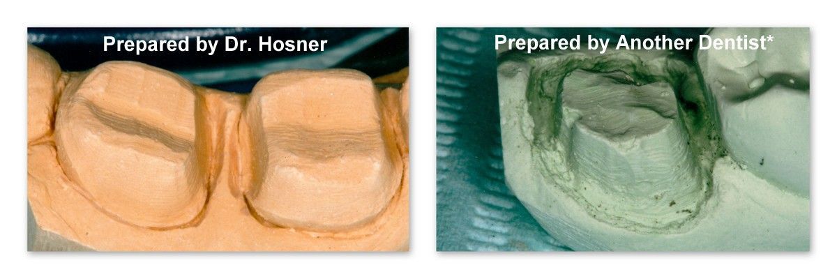 A picture of a tooth before and after being prepared by another dentist