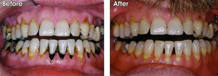 A before and after picture of a person's teeth.