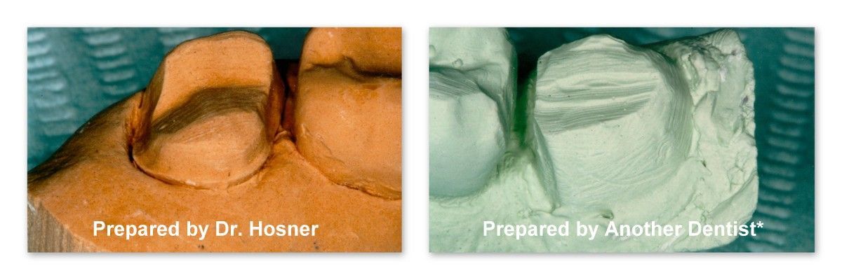 A picture of a tooth and a picture of a tooth prepared by another center