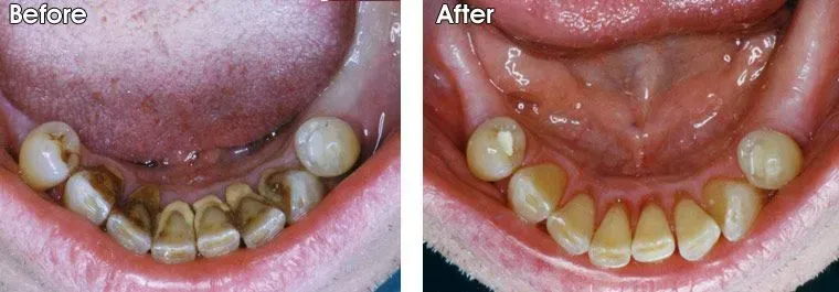 A before and after picture of a person's teeth
