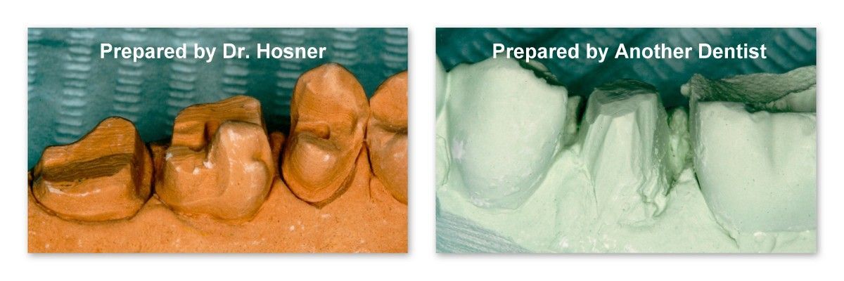 A picture of a tooth before and after being prepared by another dentist