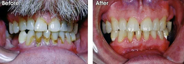A before and after picture of a man's teeth.