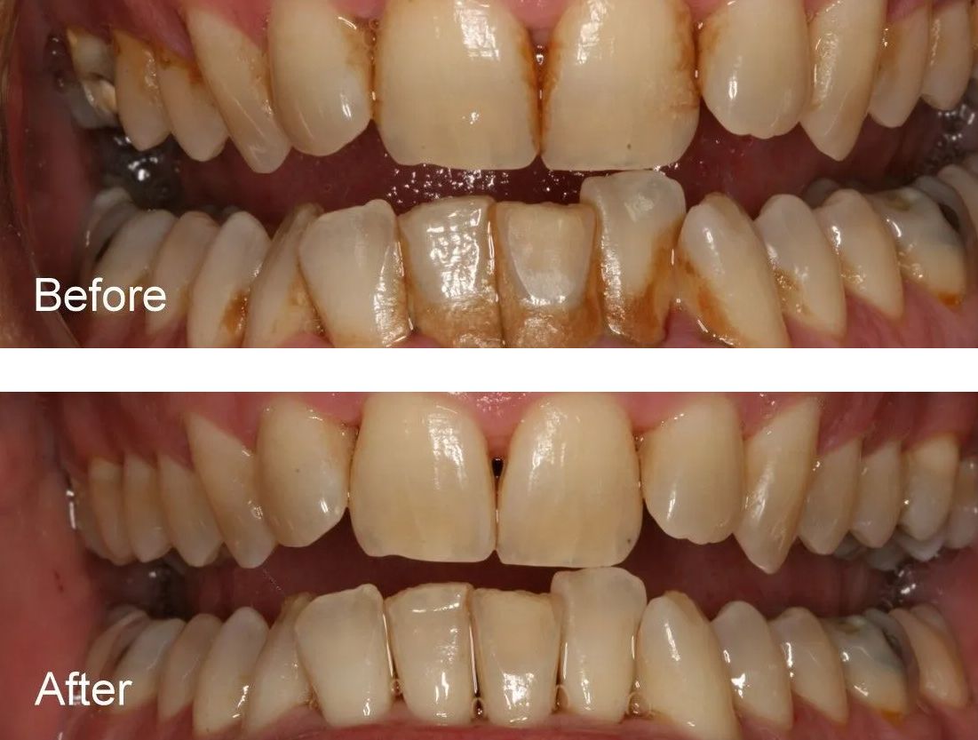 A before and after picture of a person's teeth.