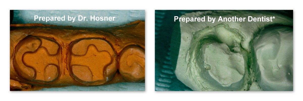 A picture of a tooth before and after being prepared by another dentist