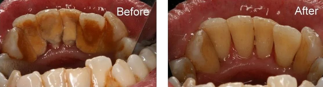 A before and after picture of a person's teeth.