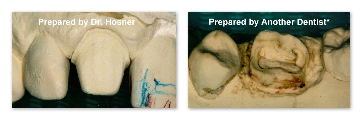 A picture of a tooth being prepared by another dentist