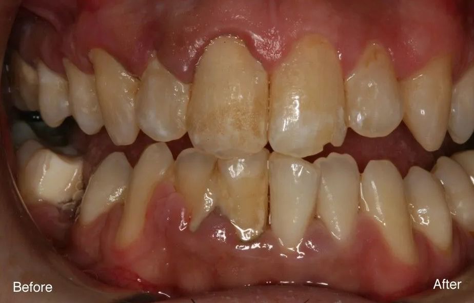 A before and after photo of a person's teeth.