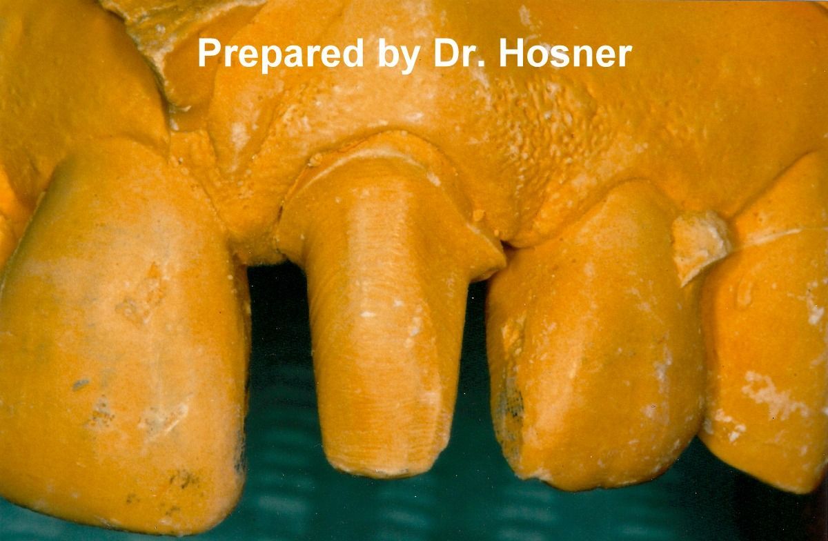 A close up of a dental model prepared by dr. hosner