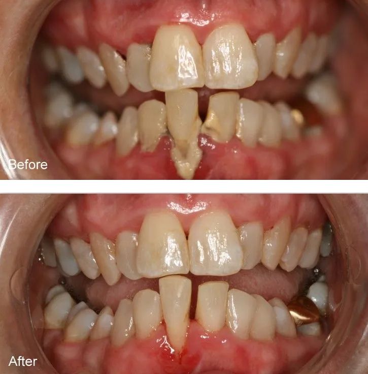 A before and after picture of a person's teeth.