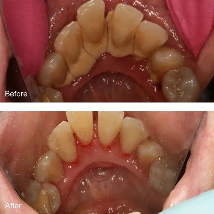 A before and after picture of a person's teeth.