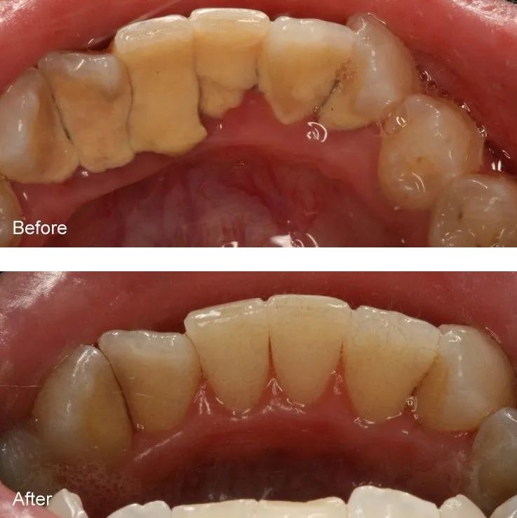 A before and after picture of a person's teeth.