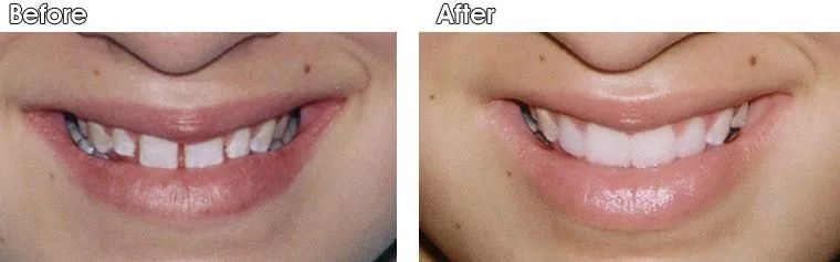 A before and after picture of a woman's smile.