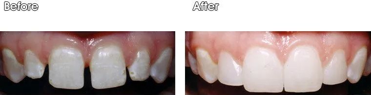 A before and after picture of a person's teeth.