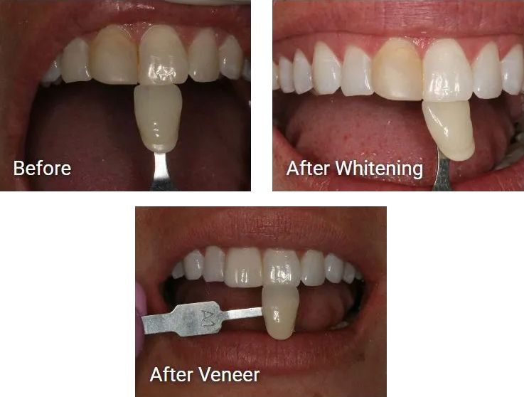 Three pictures of a person's teeth before and after whitening.