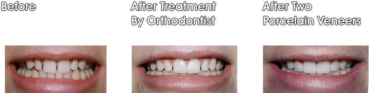 A before and after picture of a person's teeth.
