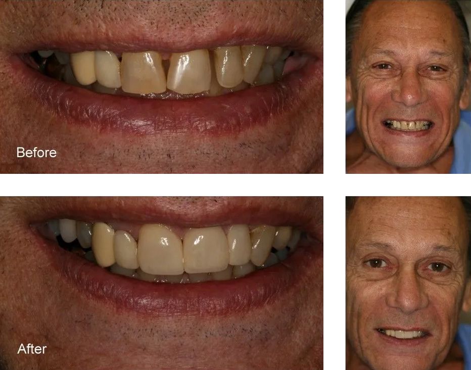 A before and after picture of a man's teeth.