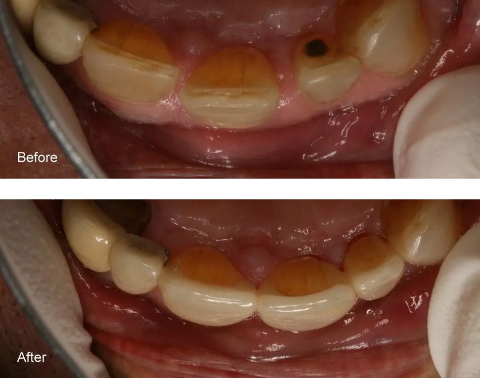 A before and after picture of a person's teeth.