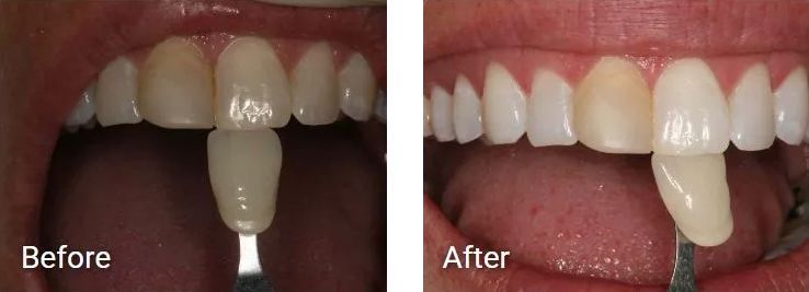 A before and after picture of a person's teeth.