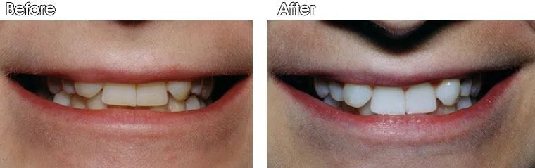 A before and after picture of a person's teeth.