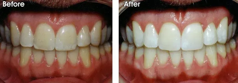 A before and after picture of a person's teeth