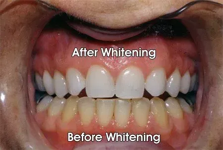 A close up of a person's teeth before and after whitening.