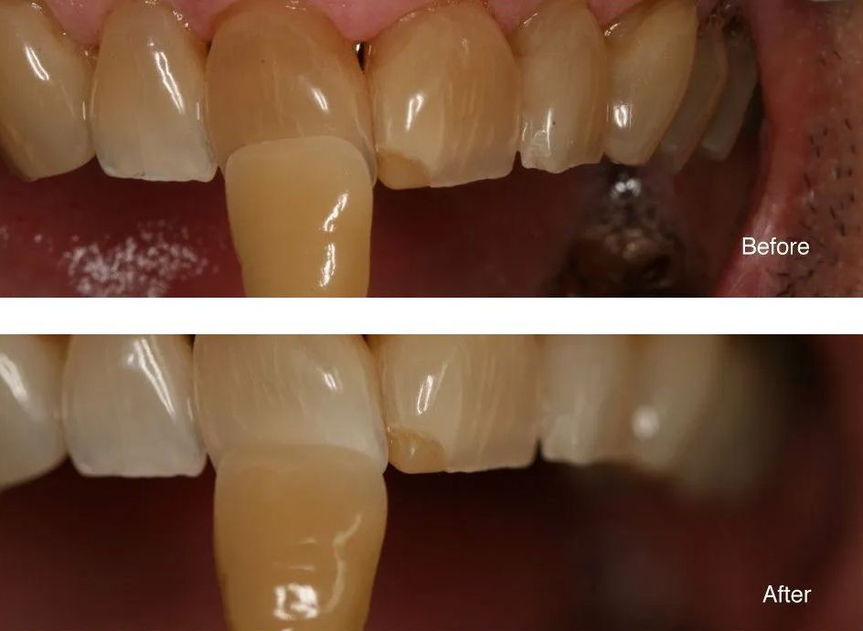 A before and after picture of a person's teeth.
