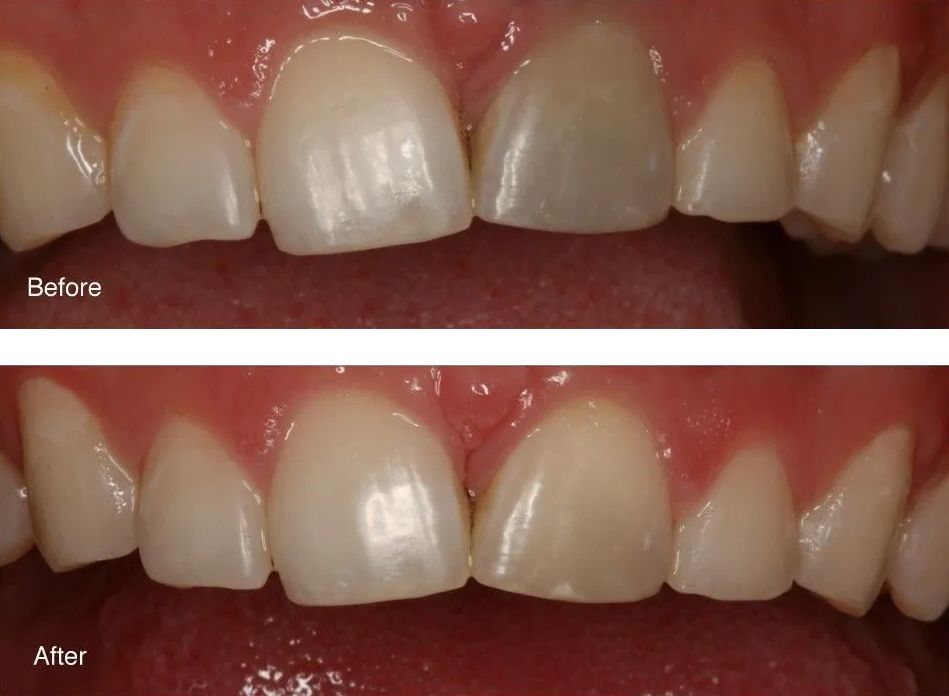 A before and after picture of a person's teeth.
