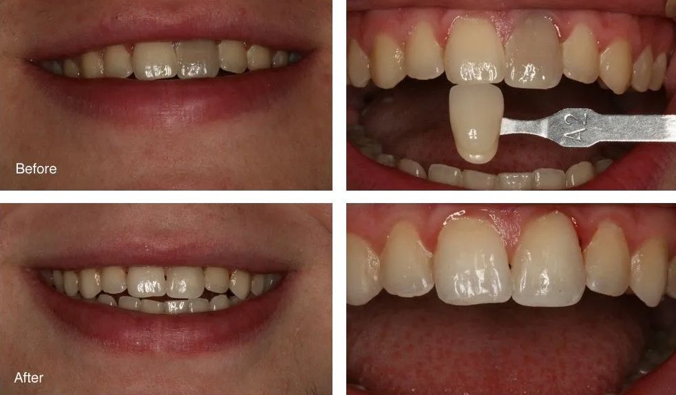 A before and after picture of a person's teeth.