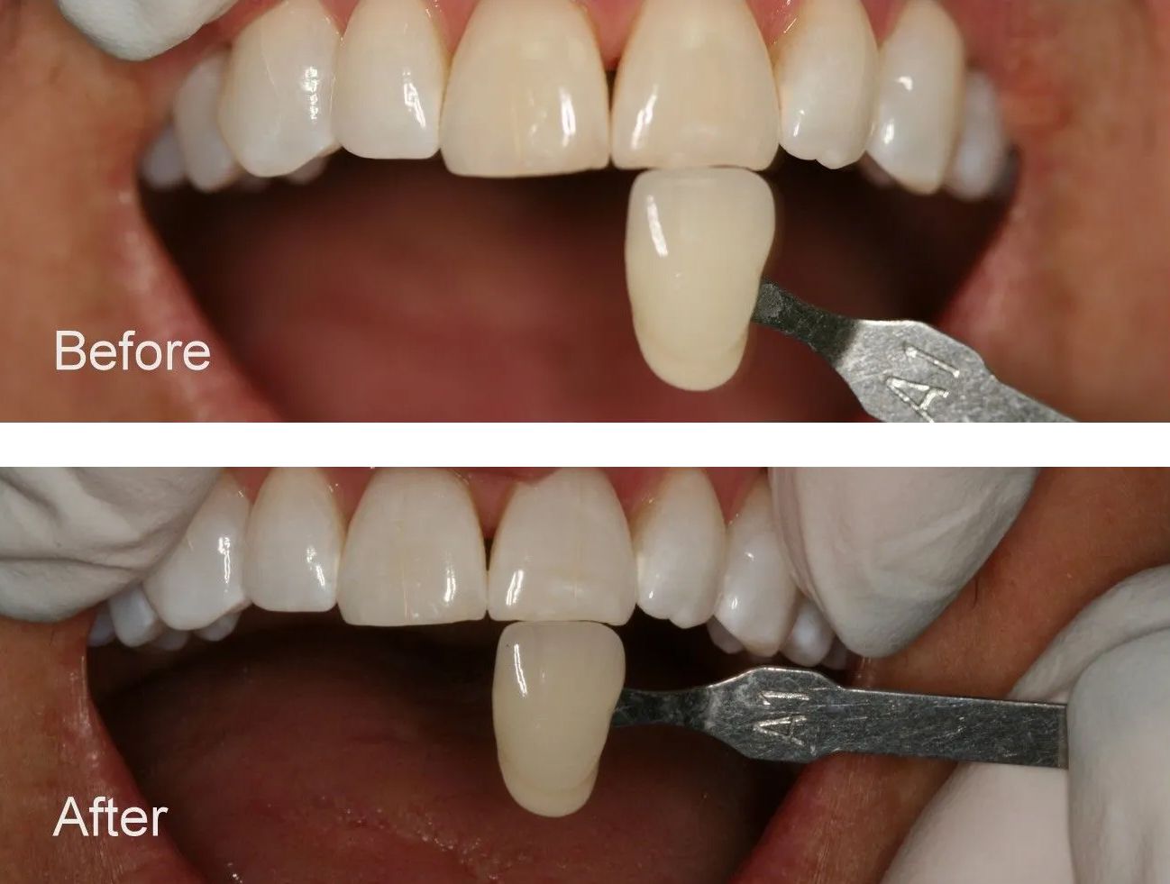 A before and after picture of a person's teeth.