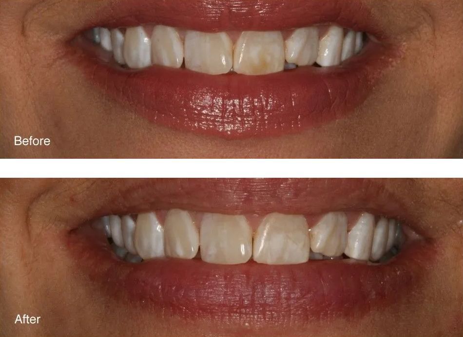 A before and after picture of a person's teeth.