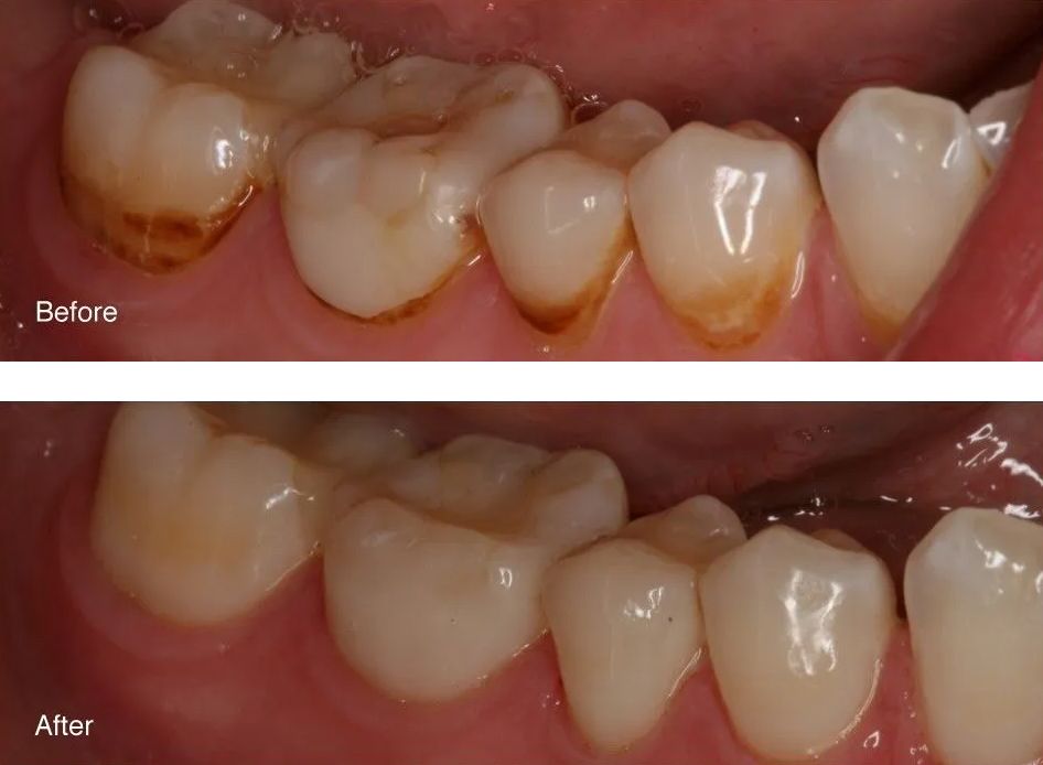 A before and after picture of a person's teeth.