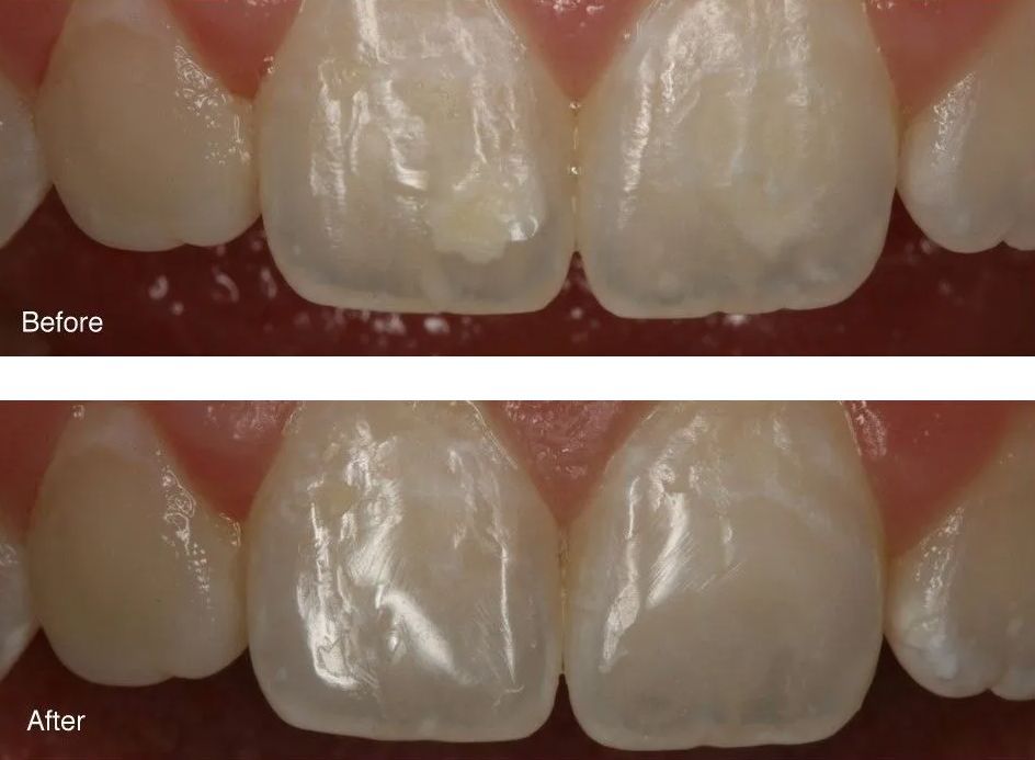 A before and after picture of a person's teeth.