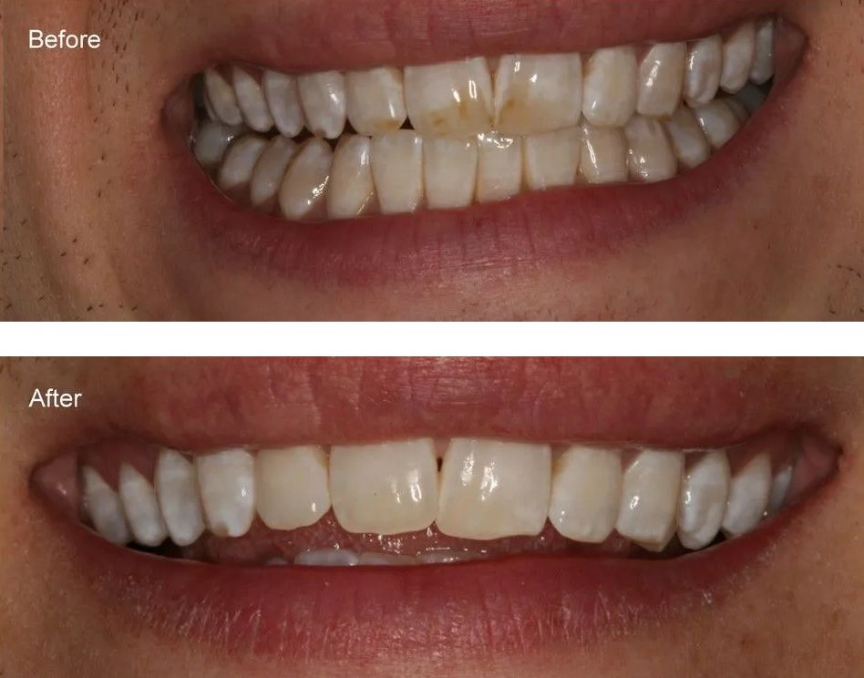 A before and after picture of a person's teeth.