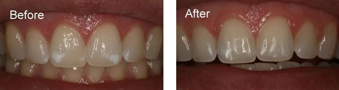 A before and after picture of a person's teeth.