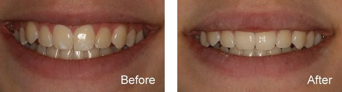 A before and after picture of a woman's teeth.