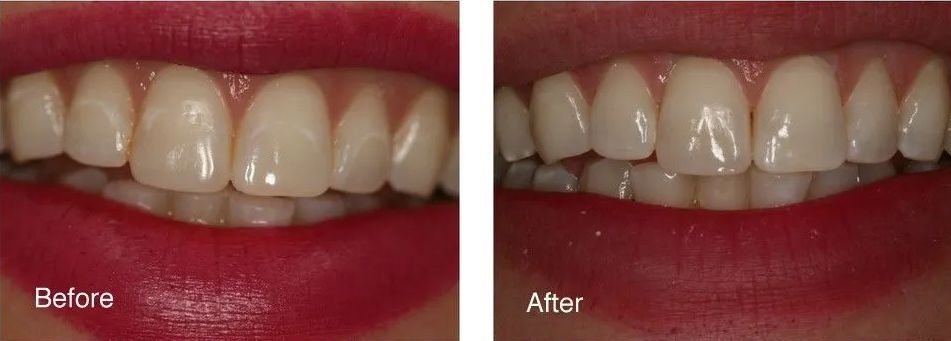 A before and after picture of a woman's teeth.