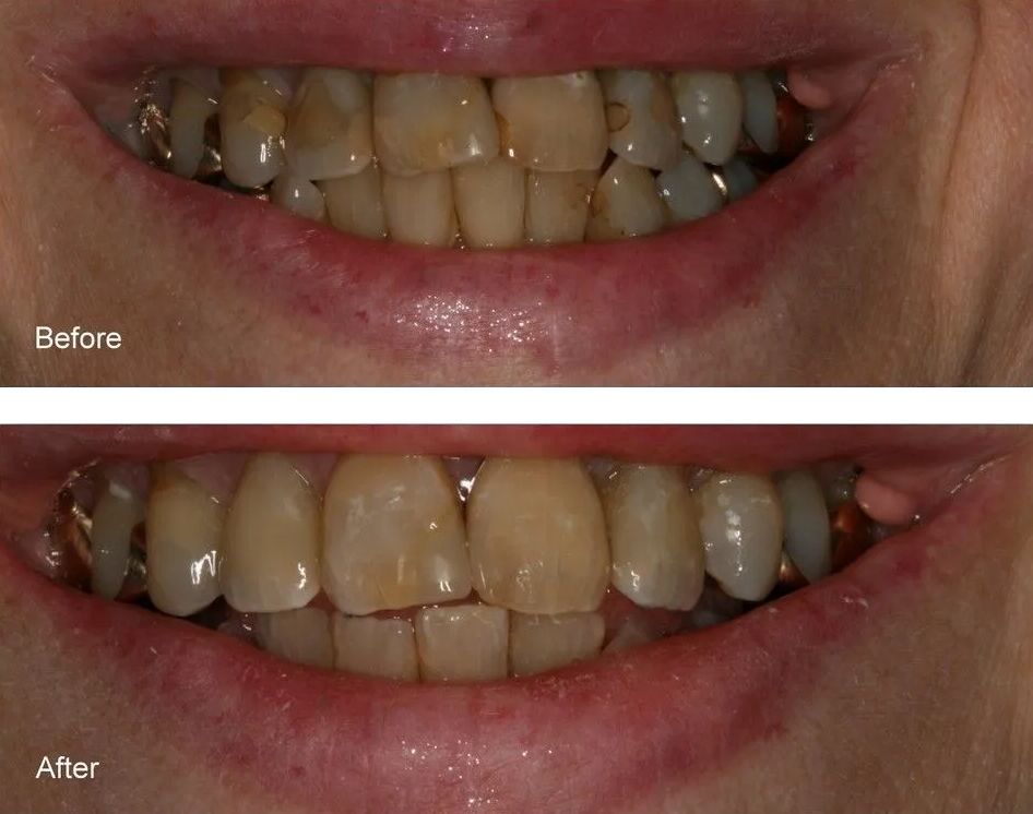 A before and after picture of a person's teeth.
