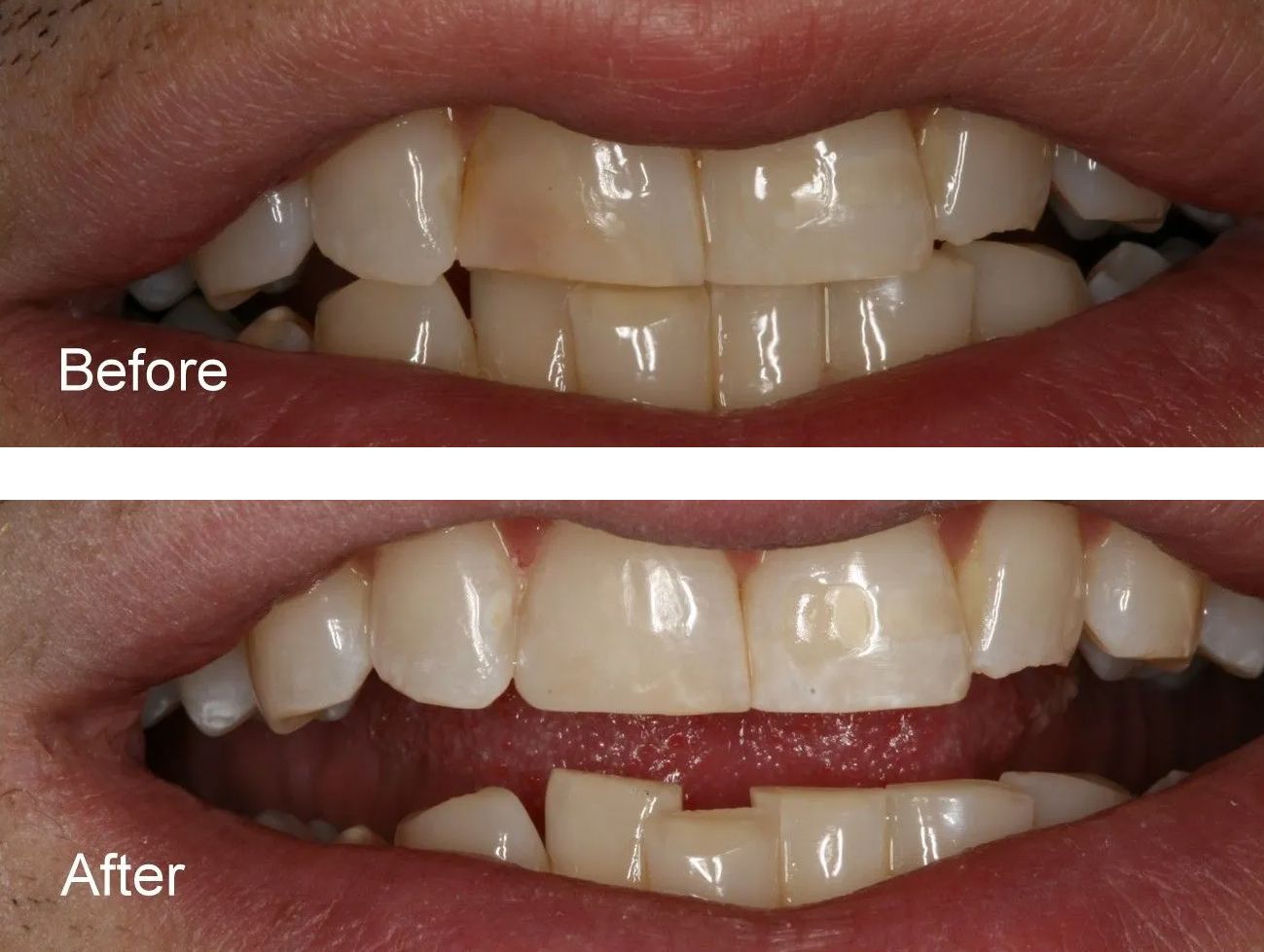 A before and after picture of a person's teeth.