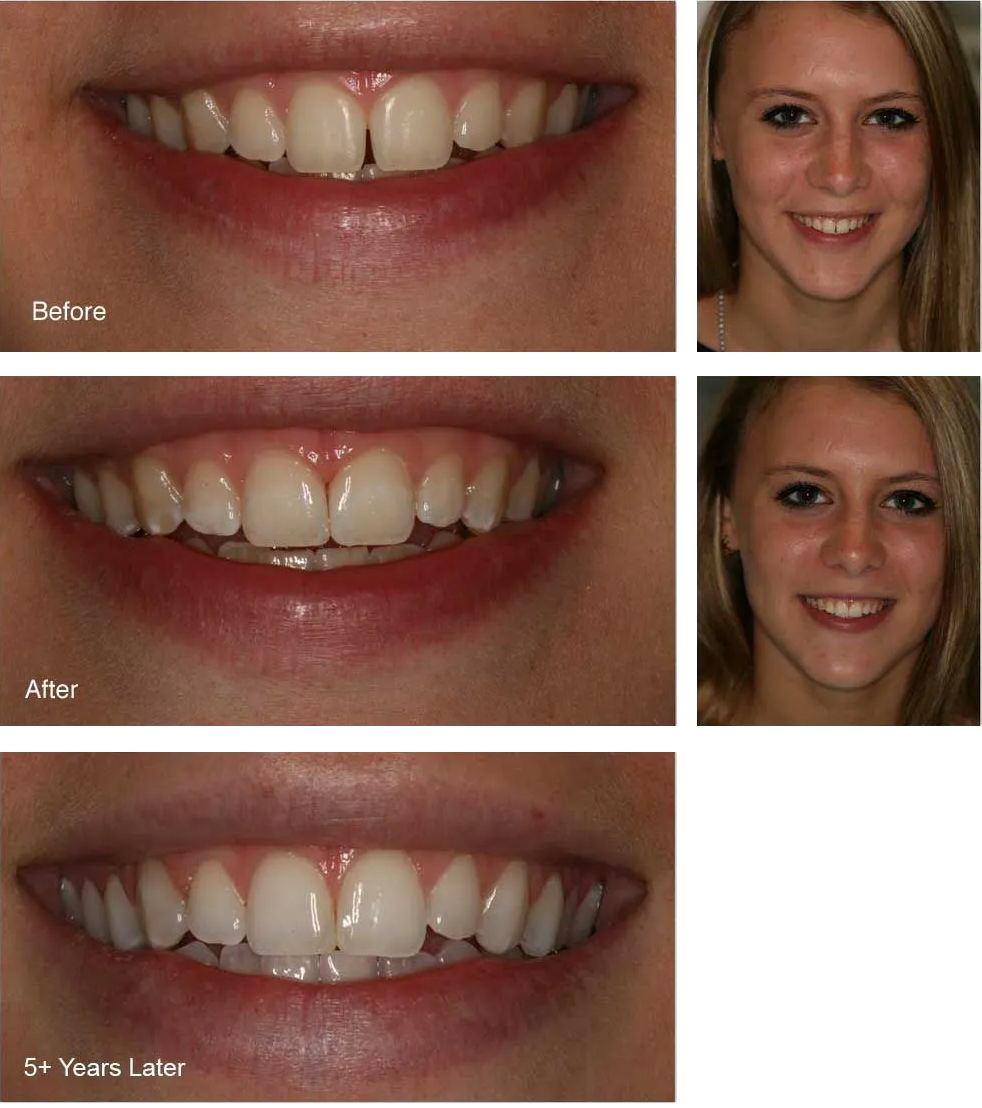 A before and after picture of a woman's teeth.