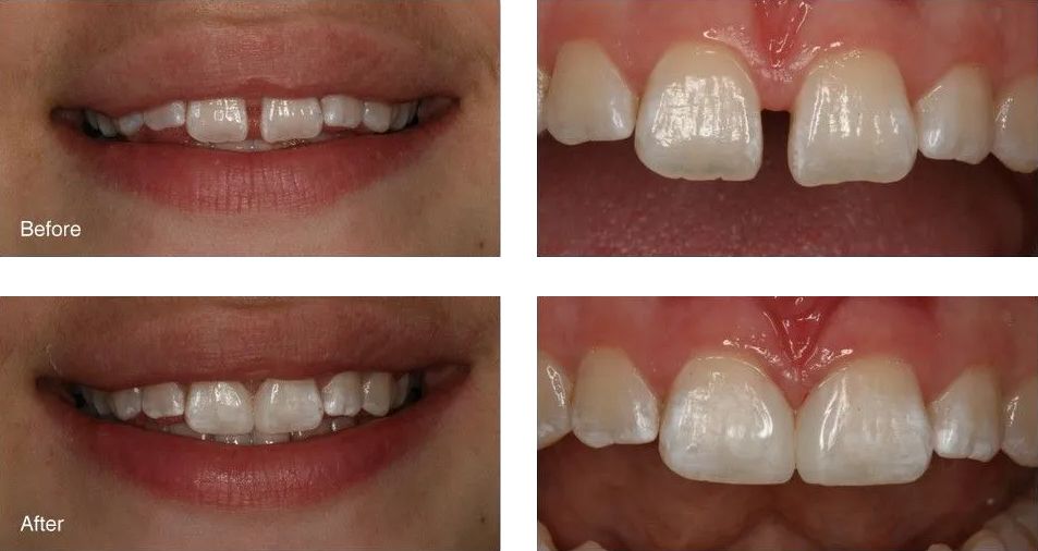 A before and after picture of a woman's teeth.