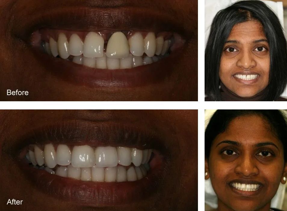 A before and after photo of a woman's teeth.