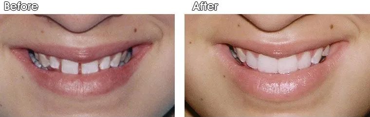 A before and after picture of a woman's smile.
