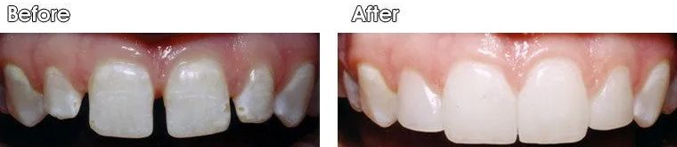 A before and after picture of a person's teeth.