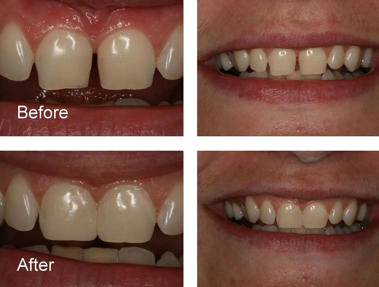 A before and after photo of a woman's teeth.