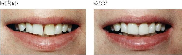 A before and after picture of a woman's teeth.