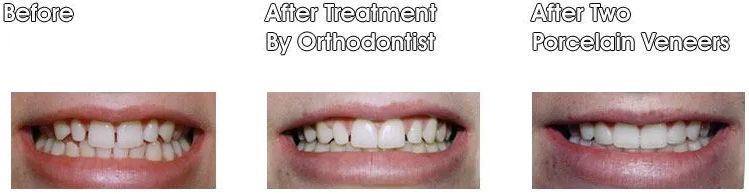 Three pictures of a woman's teeth before and after treatment.